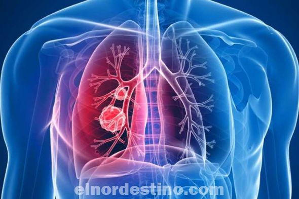 Debido a que la fibrosis quística es un trastorno heredado, se presenta entre los miembros de una misma familia, por lo que los antecedentes familiares son un factor de riesgo. Las complicaciones de la fibrosis quística pueden afectar a los sistemas respiratorio, digestivo y reproductor, así como a otros órganos. (Foto: Divulgación).